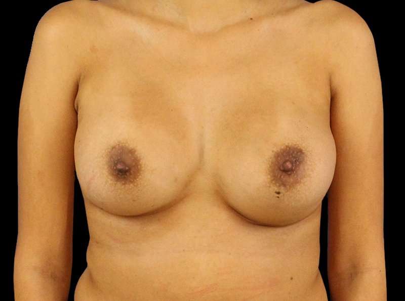 Breast Augmentation Before & After Patient #2129