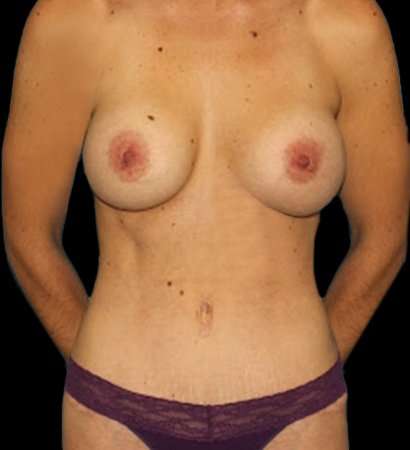 Breast Augmentation Before & After Patient #2147