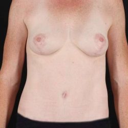 Breast Augmentation Before & After Patient #2178