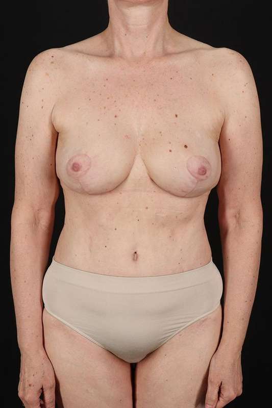 Breast Augmentation Before & After Patient #2263