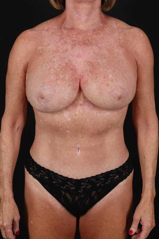 Breast Augmentation Before & After Patient #2270