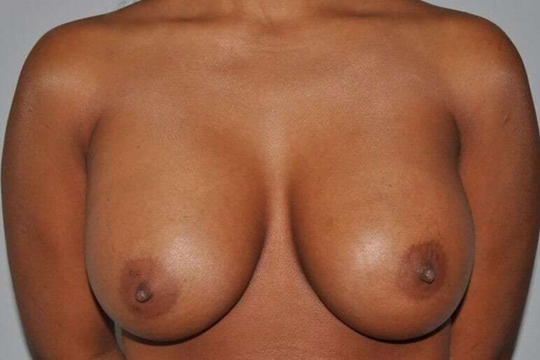 Breast Augmentation Before & After Patient #2291