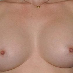Breast Augmentation Before & After Patient #2297