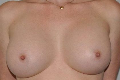 Breast Augmentation Before & After Patient #2297