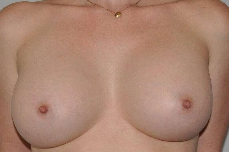 Breast Augmentation Before & After Patient #2297
