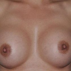 Breast Augmentation Before & After Patient #2313