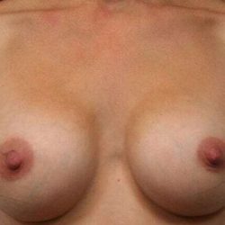 Breast Augmentation Before & After Patient #2318