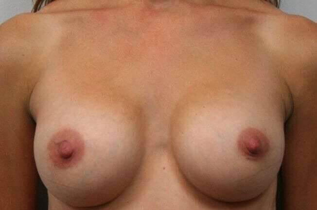 Breast Augmentation Before & After Patient #2318