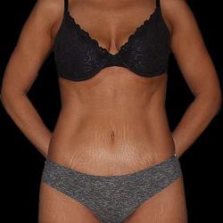 Abdominoplasty (Tummy Tuck) Before & After Patient #757