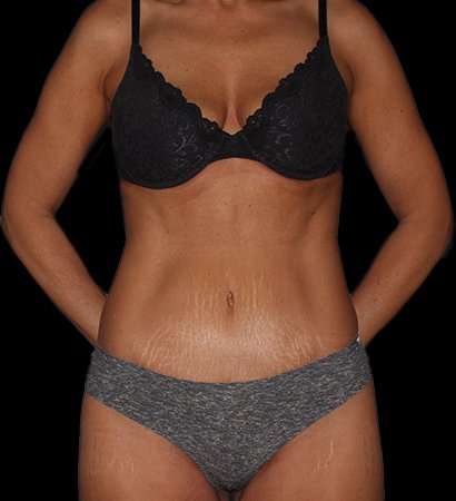 Abdominoplasty (Tummy Tuck) Before & After Patient #757