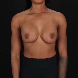 Breast Augmentation Before & After Patient #2376