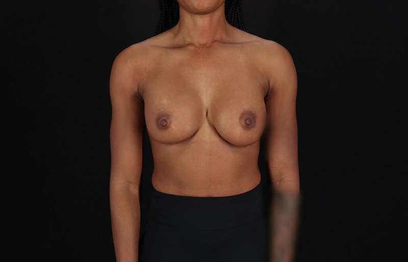 Breast Augmentation Before & After Patient #2376