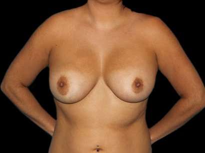 Breast Augmentation Before & After Patient #2396
