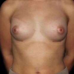 Breast Augmentation Before & After Patient #2403