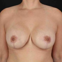 Breast Implant Revision Before & After Patient #2425