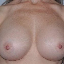 Breast Implant Revision Before & After Patient #2441
