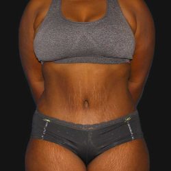 Abdominoplasty (Tummy Tuck) Before & After Patient #568