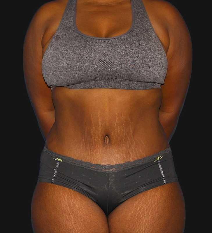 Abdominoplasty (Tummy Tuck) Before & After Patient #568