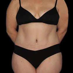 Abdominoplasty (Tummy Tuck) Before & After Patient #768