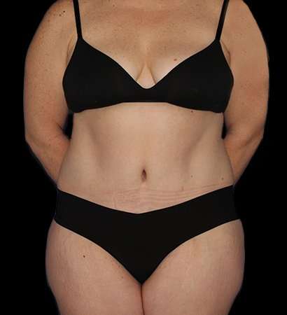 Abdominoplasty (Tummy Tuck) Before & After Patient #768