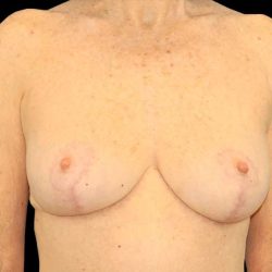 Breast Reduction Before & After Patient #2474