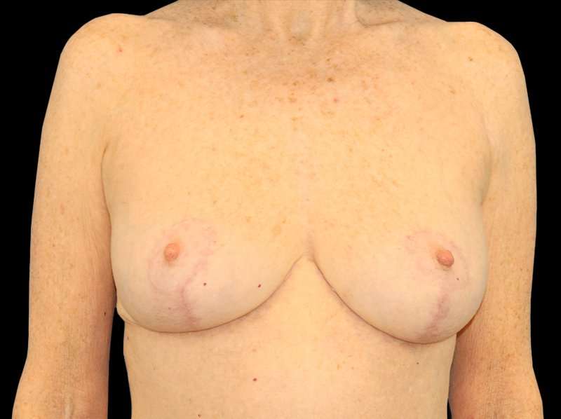 Breast Reduction Before & After Patient #2474