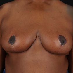 Breast Reduction Before & After Patient #2487