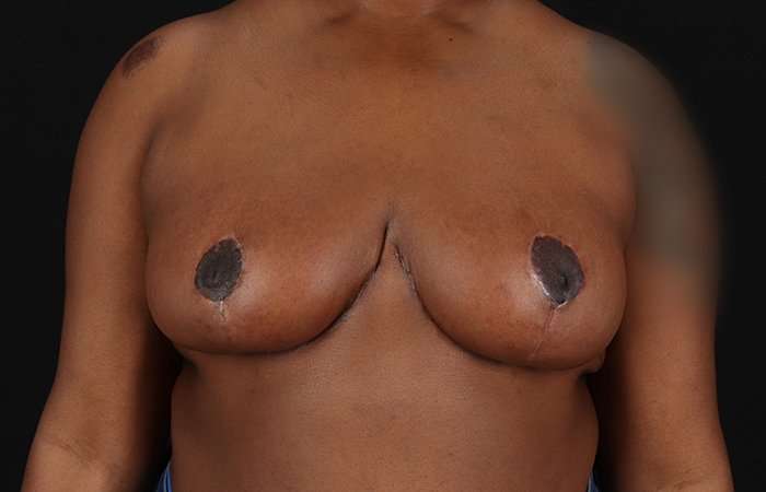 Breast Reduction Before & After Patient #2487