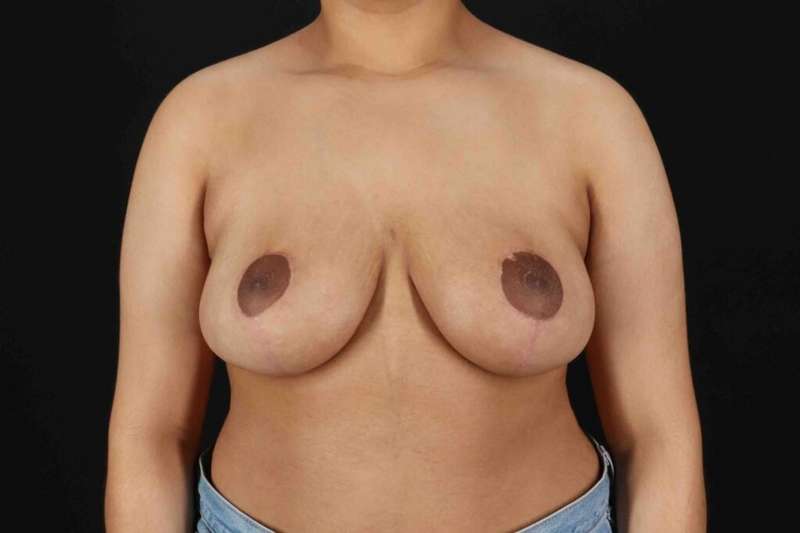 Breast Reduction Before & After Patient #2498