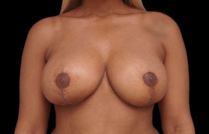 Breast Reduction Before & After Patient #2514