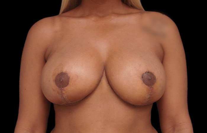 Breast Reduction Before & After Patient #2514