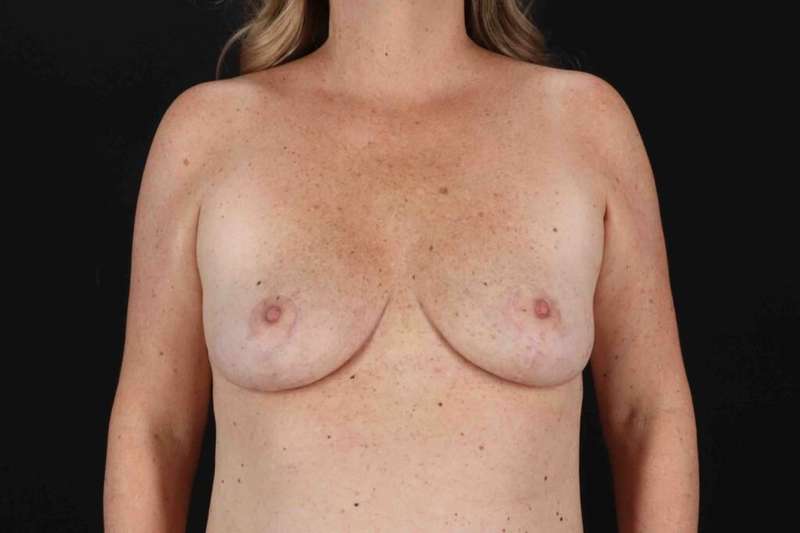 Breast Reduction Before & After Patient #2536