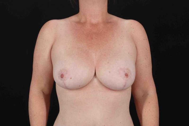 Breast Reduction Before & After Patient #2547
