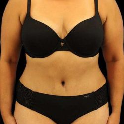 Abdominoplasty (Tummy Tuck) Before & After Patient #779