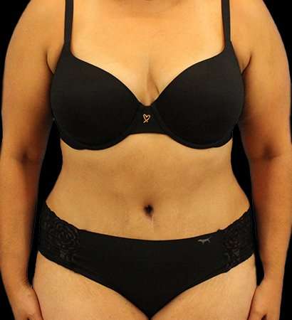 Abdominoplasty (Tummy Tuck) Before & After Patient #779