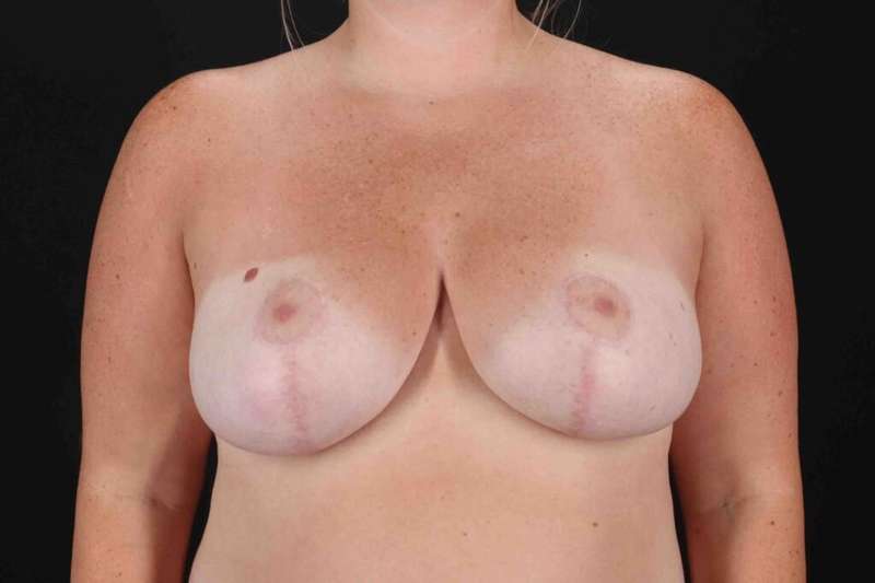 Breast Reduction Before & After Patient #2558