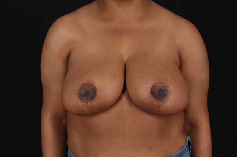 Breast Reduction Before & After Patient #2580