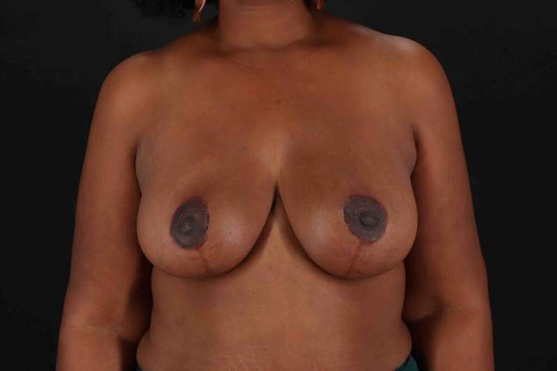 Breast Reduction Before & After Patient #2591