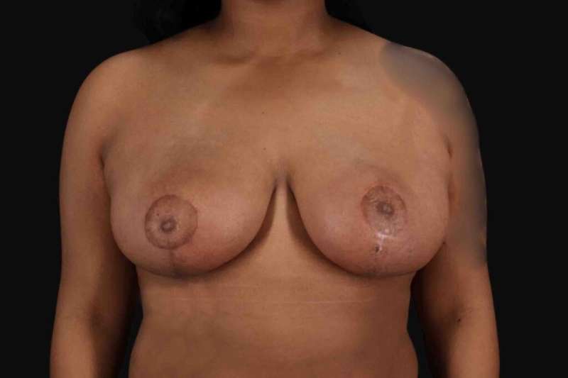 Breast Reduction Before & After Patient #2602