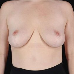Breast Reduction Before & After Patient #2624