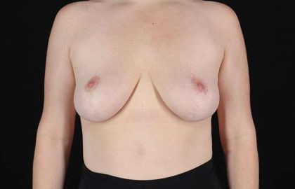 Breast Reduction Before & After Patient #2624