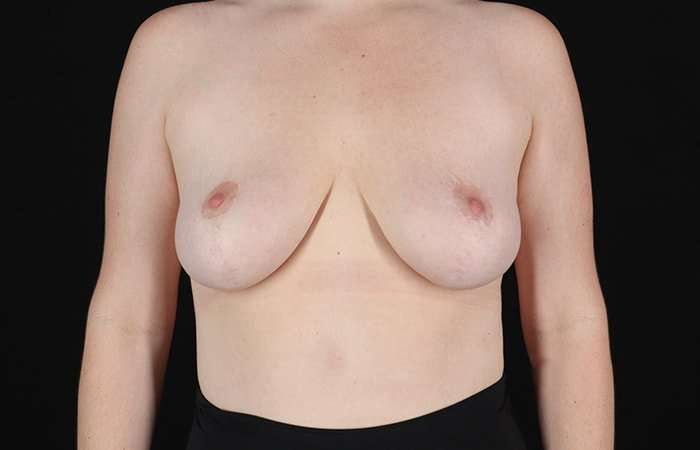 Breast Reduction Before & After Patient #2624