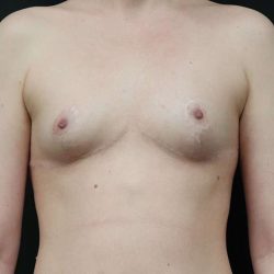 Breast Reduction Before & After Patient #2635