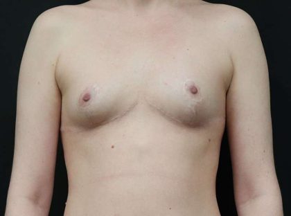 Breast Reduction Before & After Patient #2635