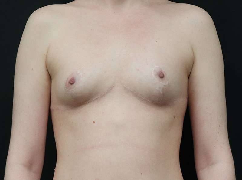 Breast Reduction Before & After Patient #2635