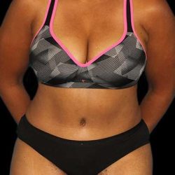 Abdominoplasty (Tummy Tuck) Before & After Patient #790