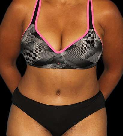 Abdominoplasty (Tummy Tuck) Before & After Patient #790