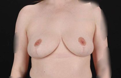 Breast Reduction Before & After Patient #2687