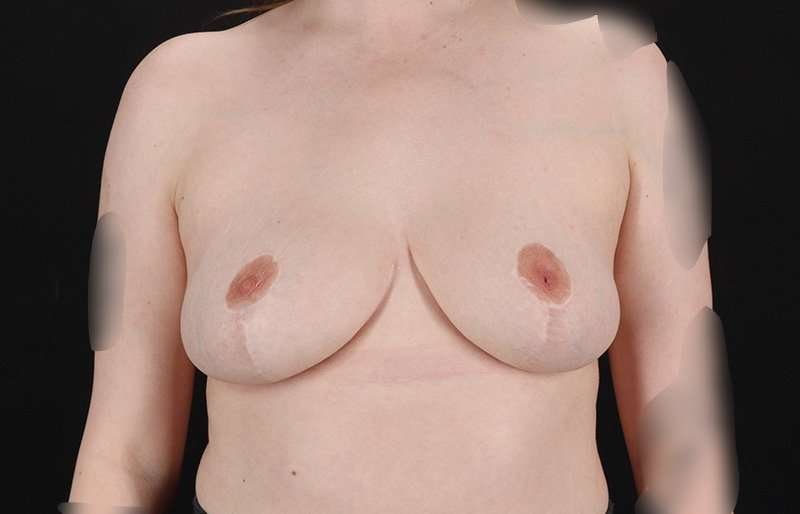 Breast Reduction Before & After Patient #2687