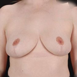 Breast Reduction Before & After Patient #2693